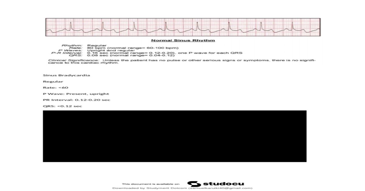 Relias Dysrhythmia Basic A Test – 2025/2026 – Complete Questions and Correct Answers